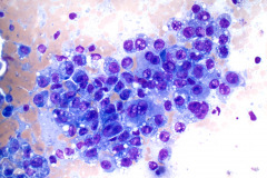 Non-Gyn Smear Diff-Quik 10x