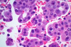 Surgical biopsy slide H&E, 60x