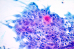 Non-Gyn smear Pap stain 40x